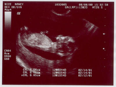 Ultrasound of baby